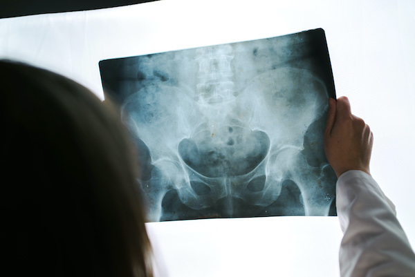 doctor looking at patient hip x-ray