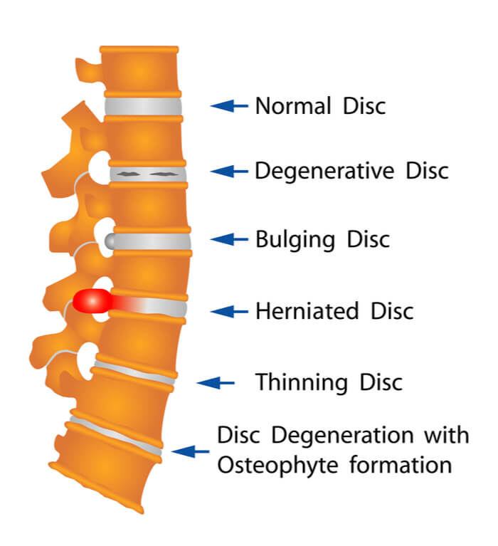 Medical illustration of spinal with different labels of injury